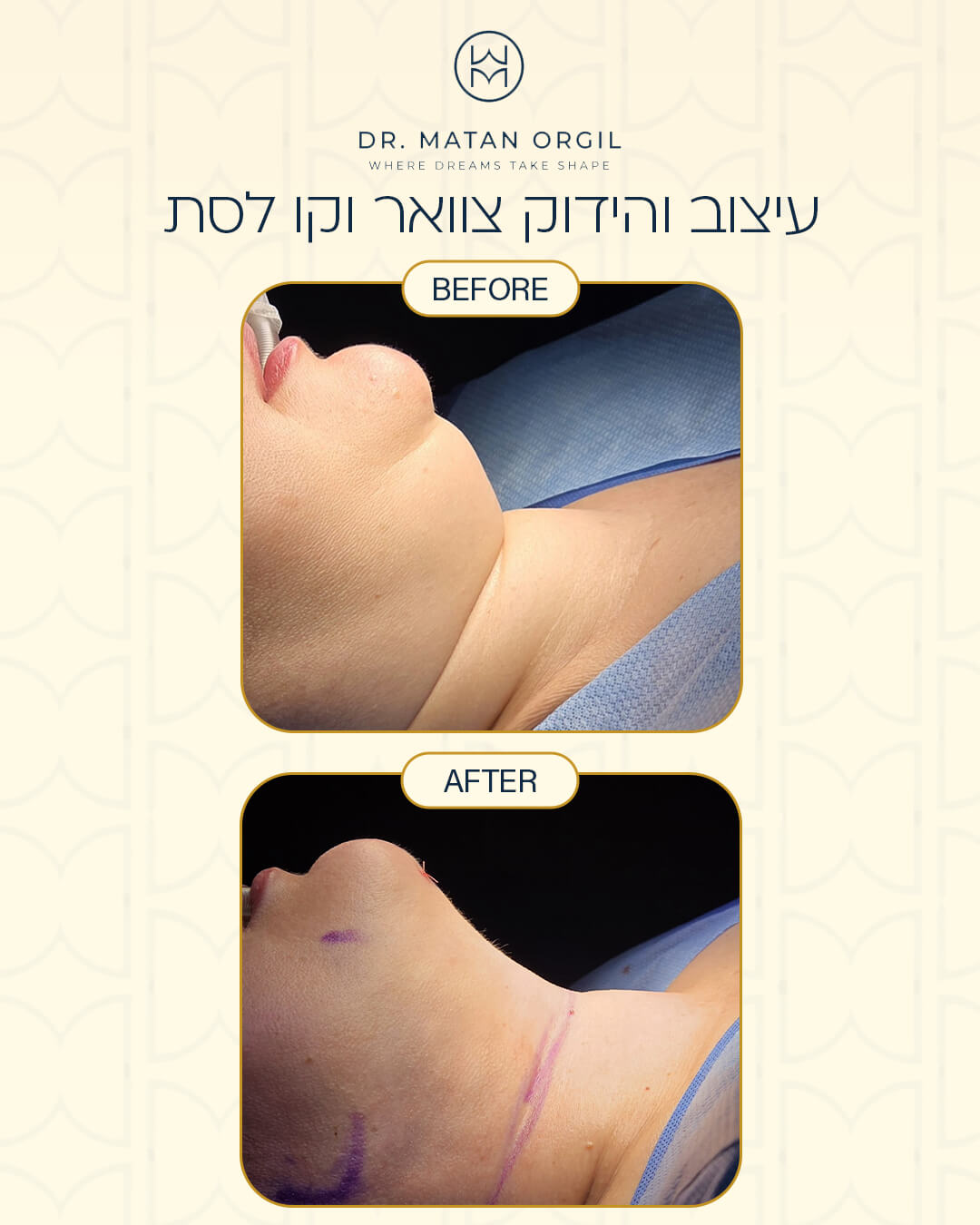 תוצאת טיפול אסתטי 3